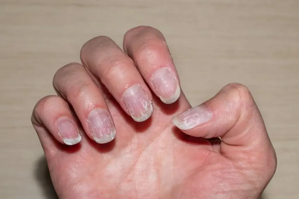 Nail Psoriasis — Psoriasis