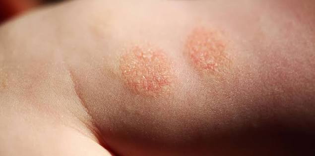 Nummular Eczema — Eczema