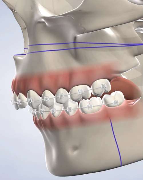 Orthognathic surgery procedure