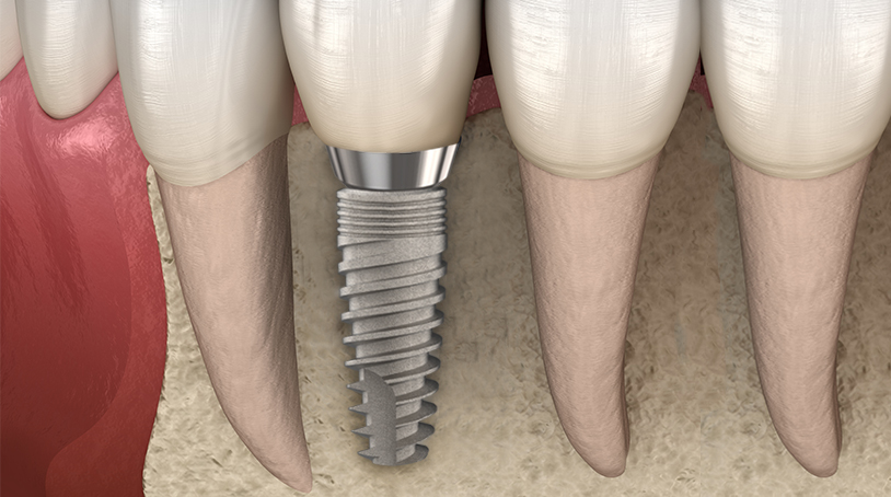 Osseointegration healing dental implant
