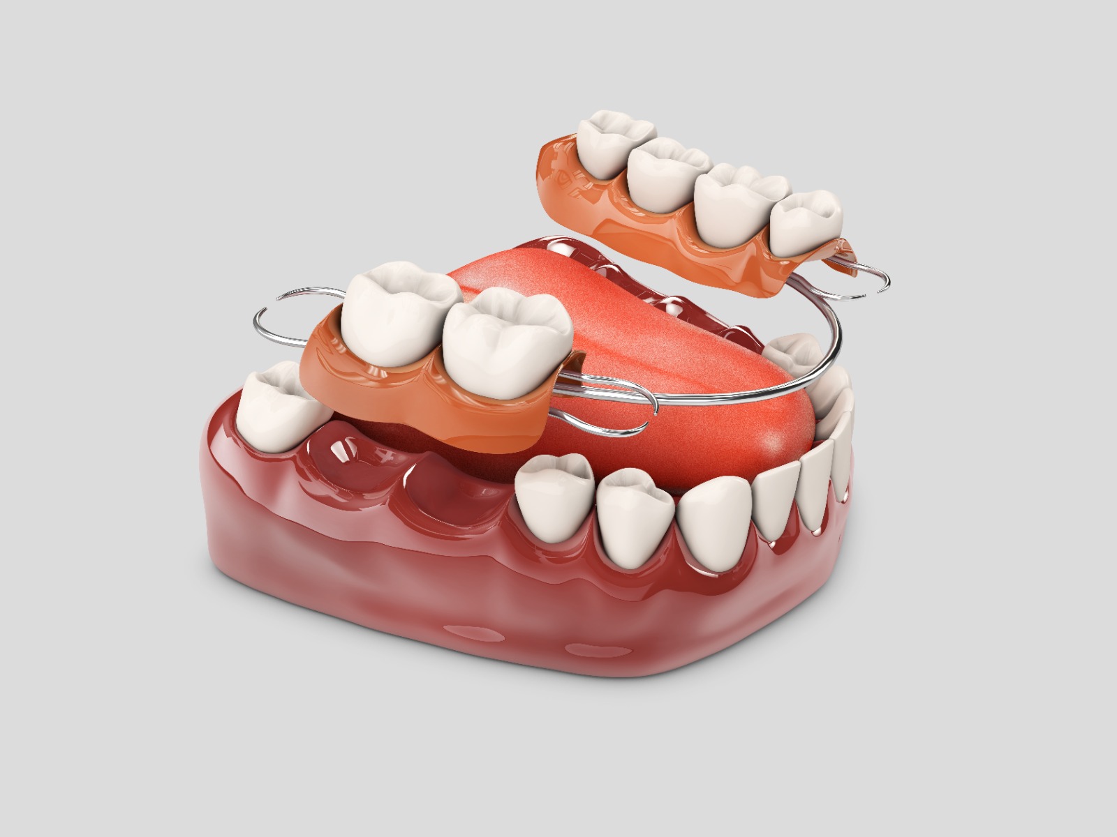 Partial dentures