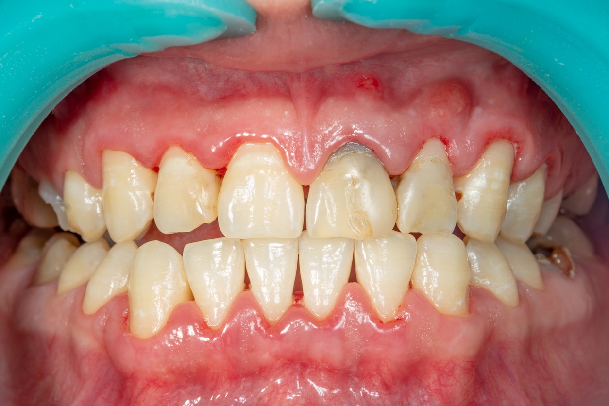Understanding Periodontal Diseases & Flap