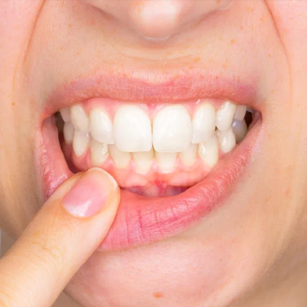 Periodontal Diseases & Flap at Aliva Aesthetics, Vijayawada