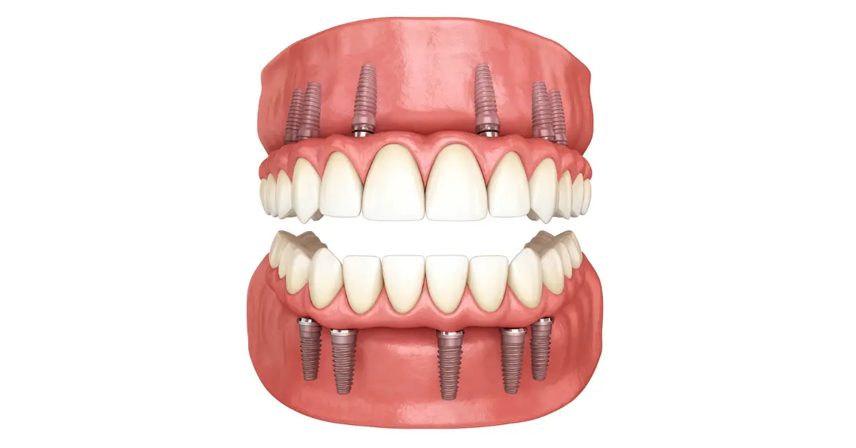Upper lower full arch implant