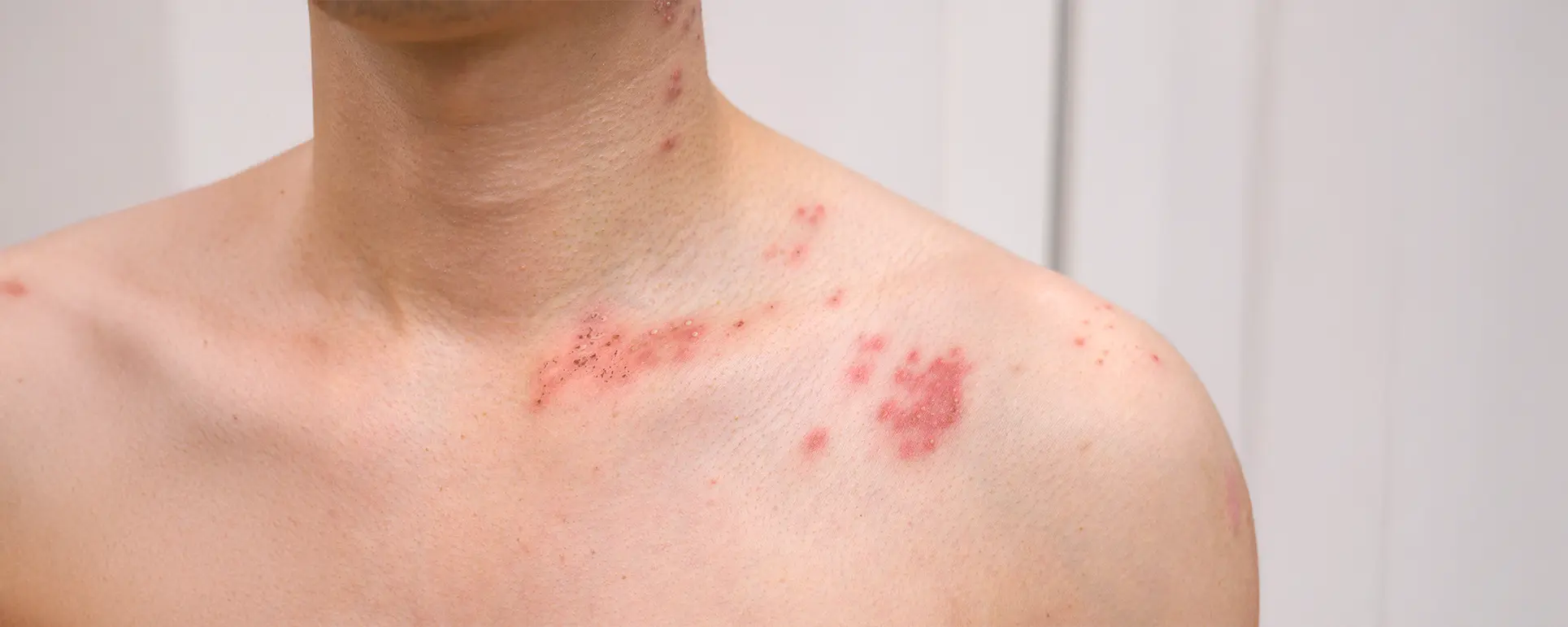 Photosensitive Rashes — Skin Allergies & Rashes