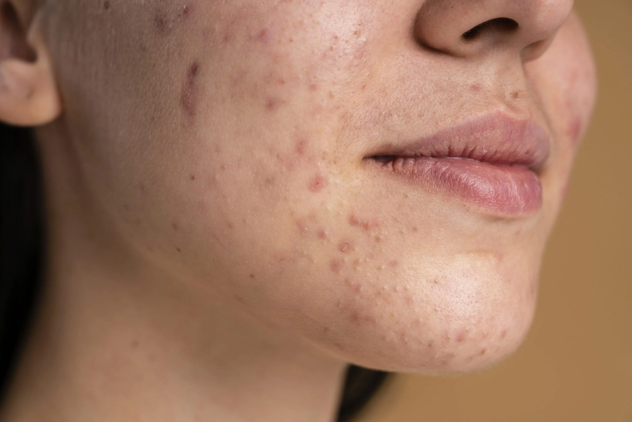 Pigmentation