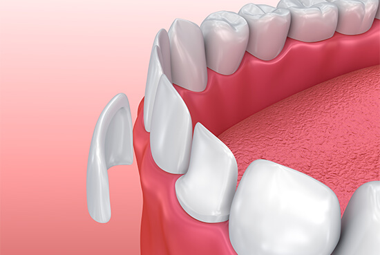 Porcelain veneers placement smile