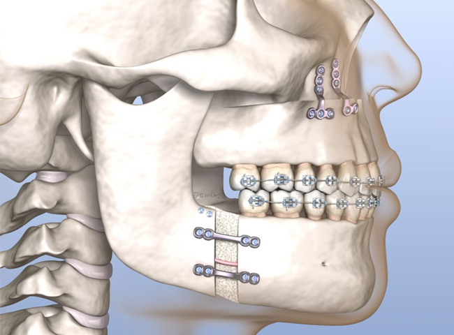 Post-surgical orthodontics jaw