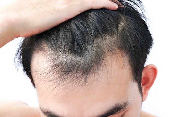 Early receding hairline regrowth therapy