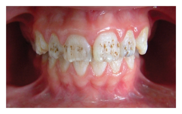 Recurrent decay filling replacement