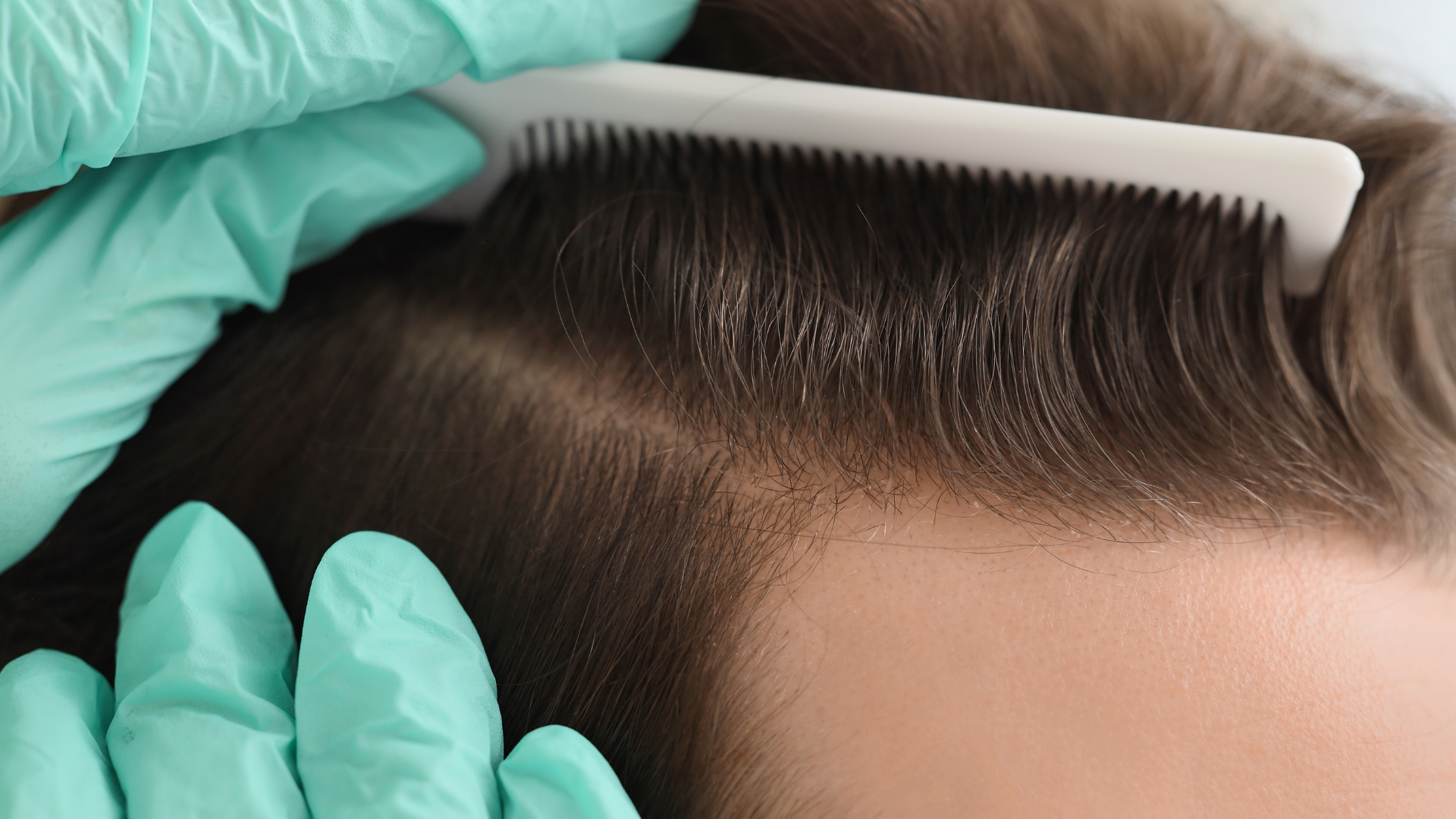Mesotherapy scalp micro-injection treatment for hair regrowth