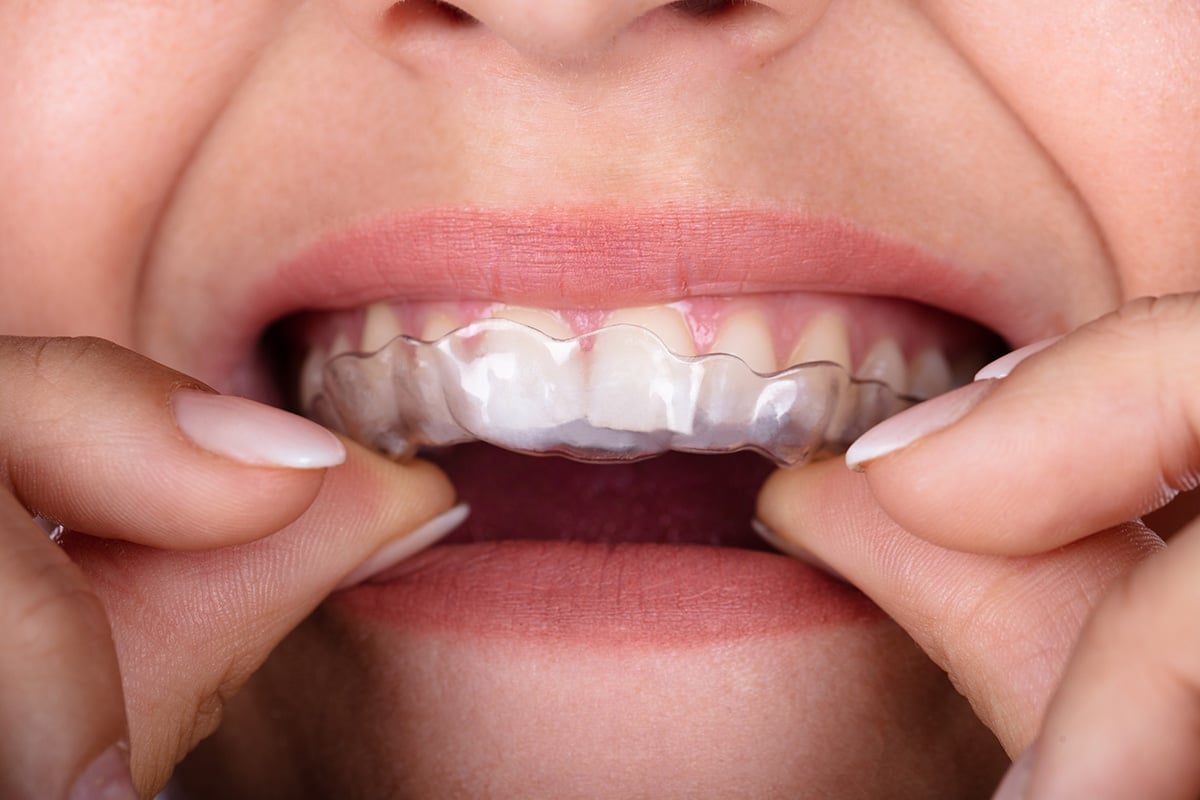 Refinement aligners orthodontic