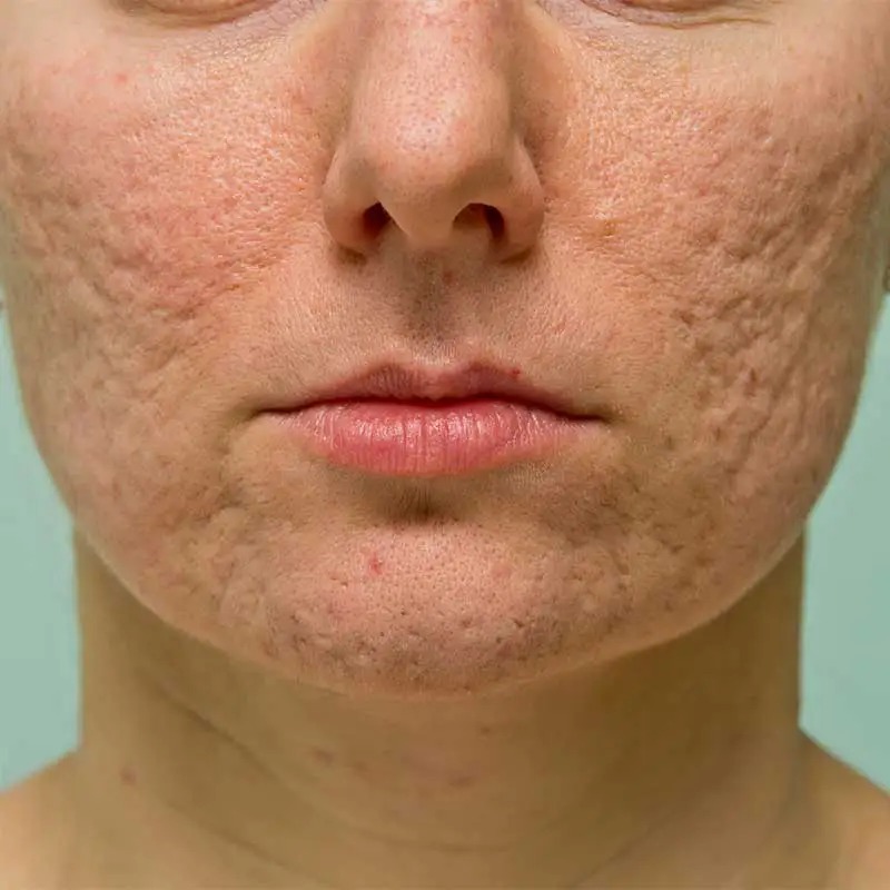 Rough uneven skin texture