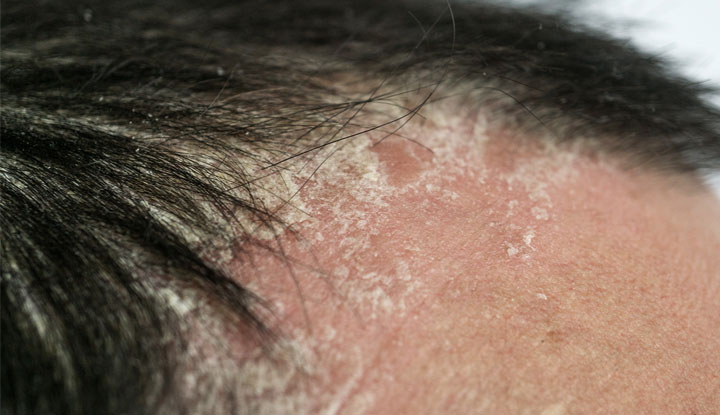 Scalp psoriasis plaques treatment