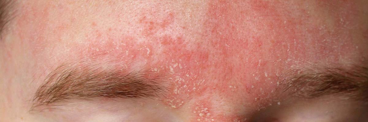 Seborrhoeic Dermatitis — Eczema