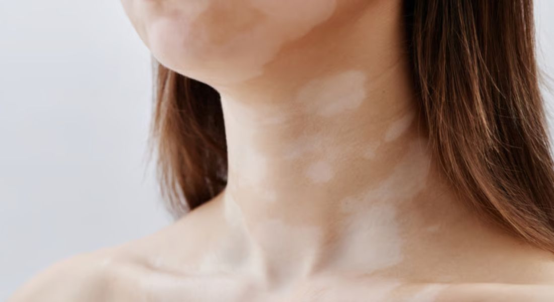 Segmental Vitiligo — Vitiligo