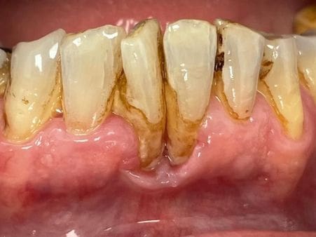Severe periodontitis advanced gum