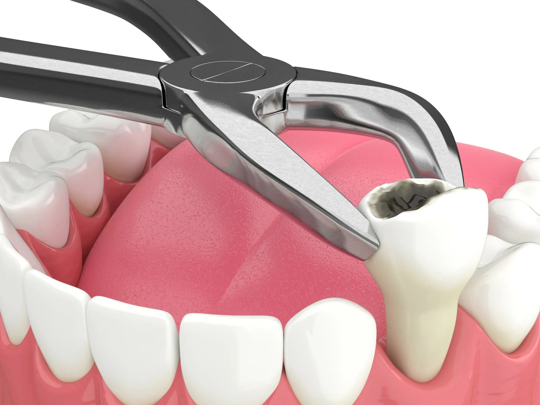 Simple wisdom tooth extraction