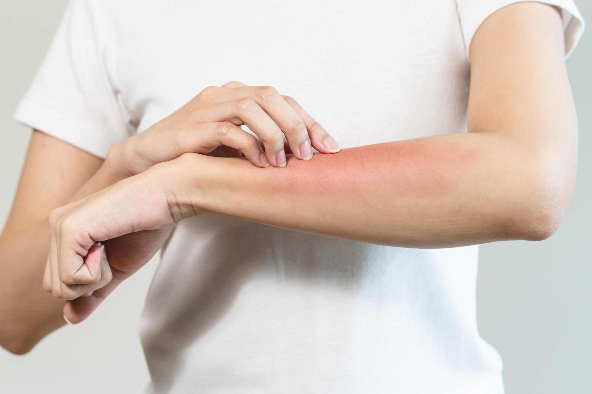 Skin Allergies & Rashes at Aliva Aesthetics Vijayawada