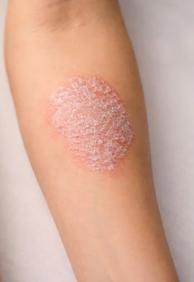 Before skin allergies & rashes treatment