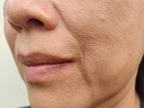 Skin laxity loss of firmness