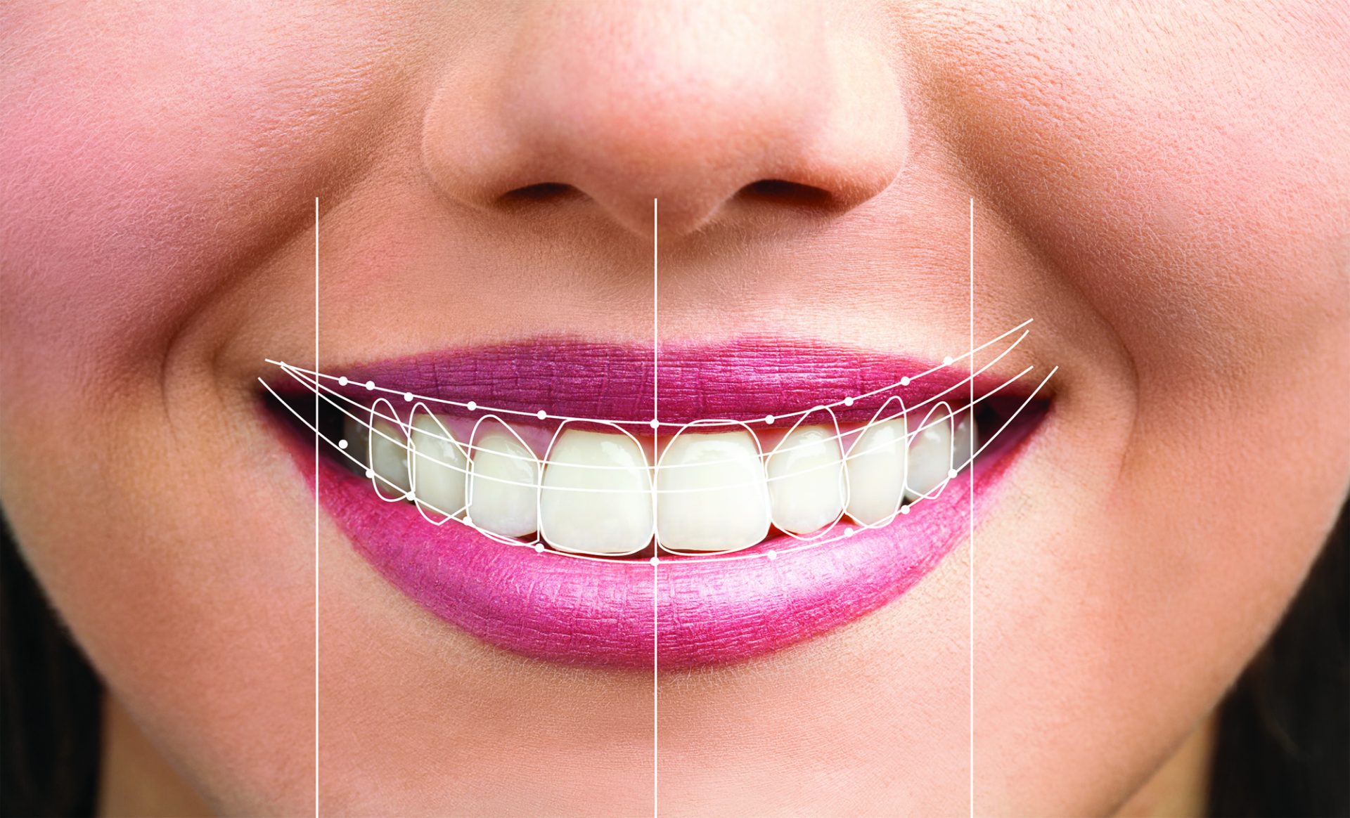 Understanding Smile Designing