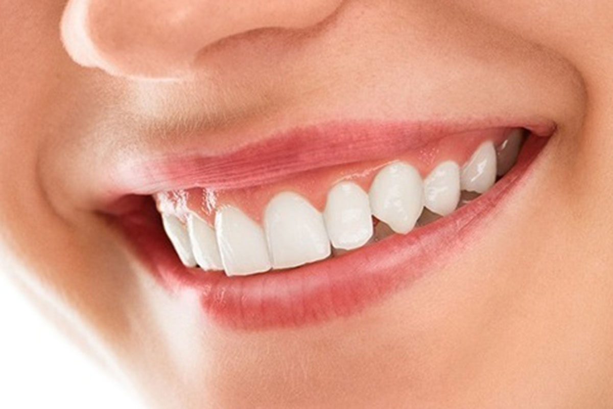Smile makeover cosmetic consultation