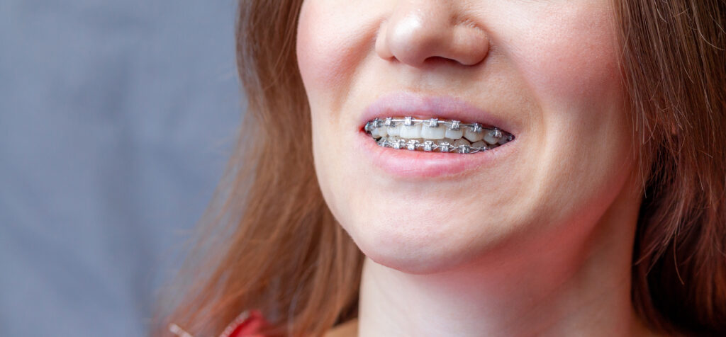 Overbite correction braces dental