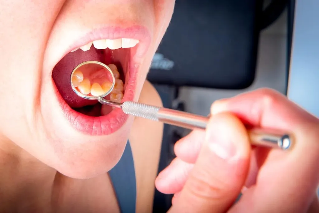 Soft tissue wisdom tooth impaction