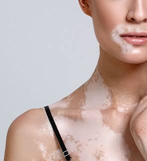 Targeted Excimer Therapy — Vitiligo at Aliva Aesthetics