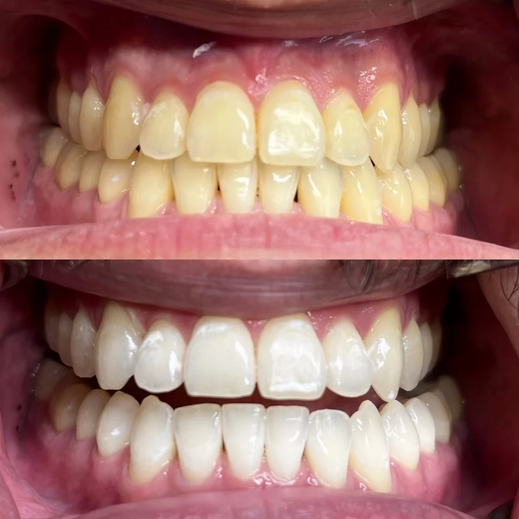 Teeth Whitening