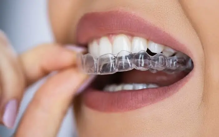 Progress check-up aligners dental
