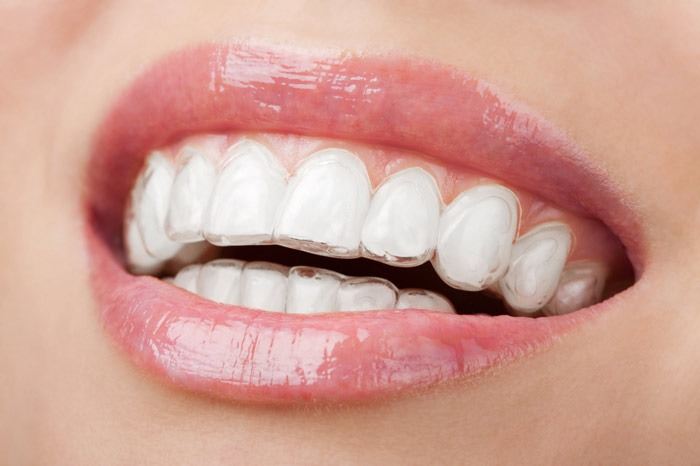 Tooth Aligners at Aliva Aesthetics, Vijayawada