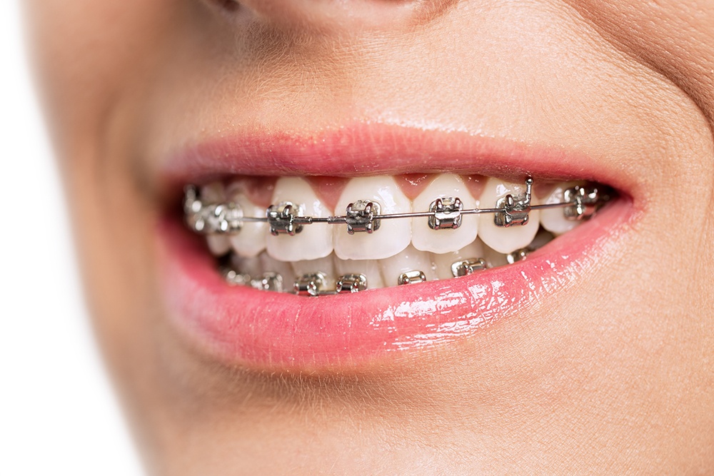 Underbite correction orthodontic