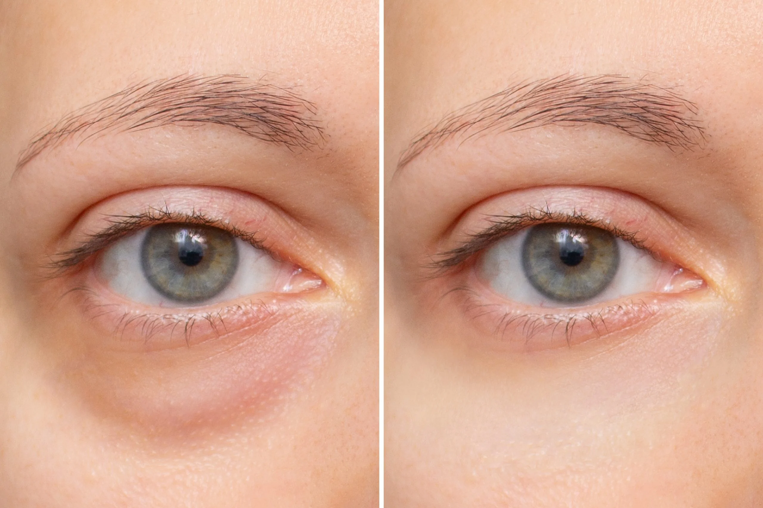Under Eye Treatment