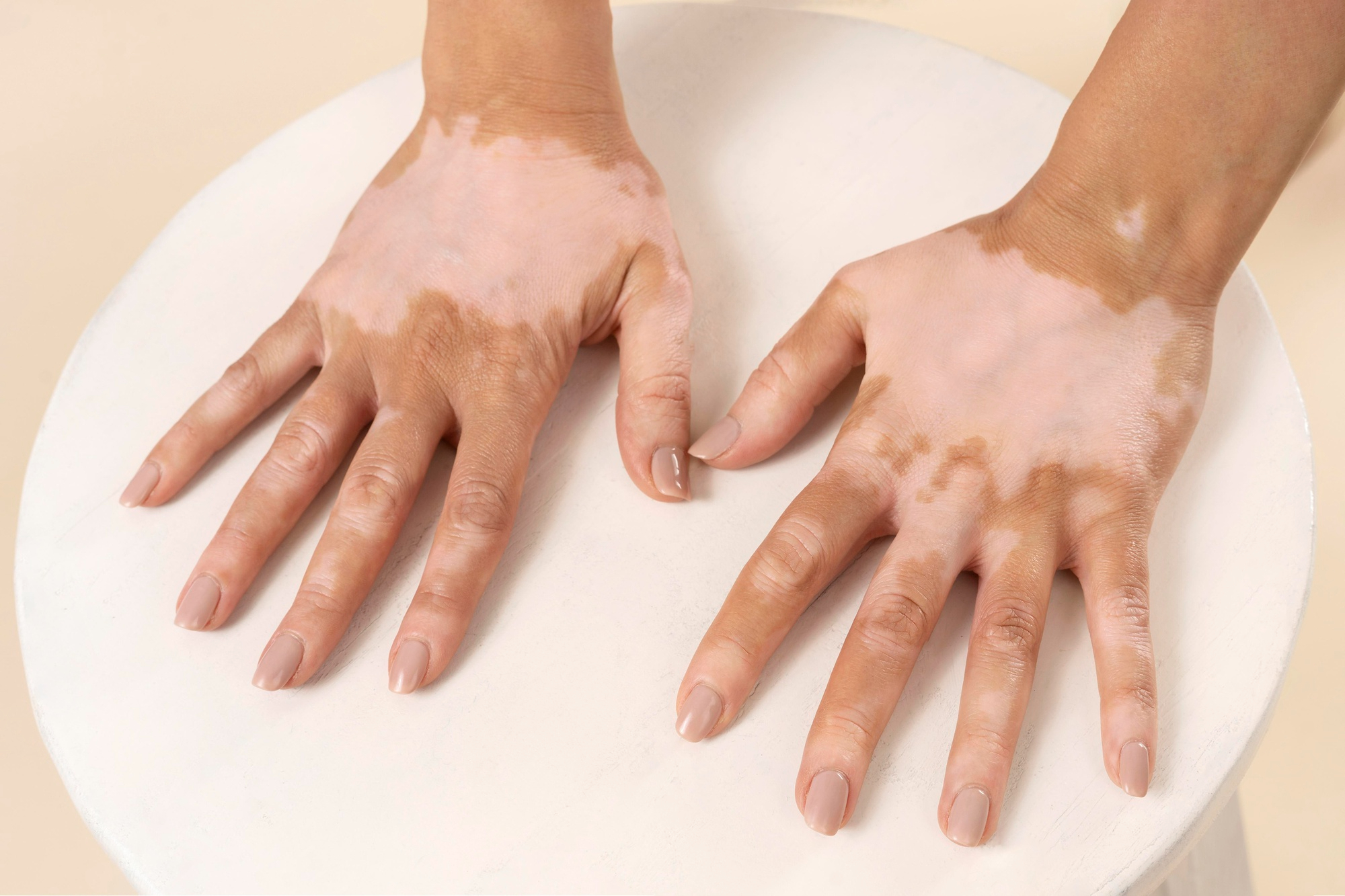 Vitiligo at Aliva Aesthetics Vijayawada