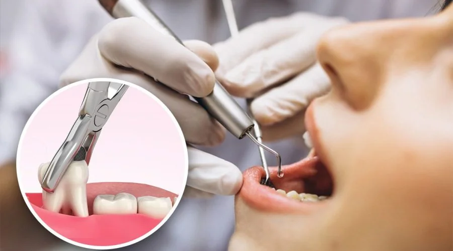 Wisdom Tooth Extraction