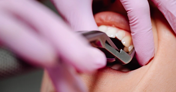 Understanding Wisdom Tooth Extraction