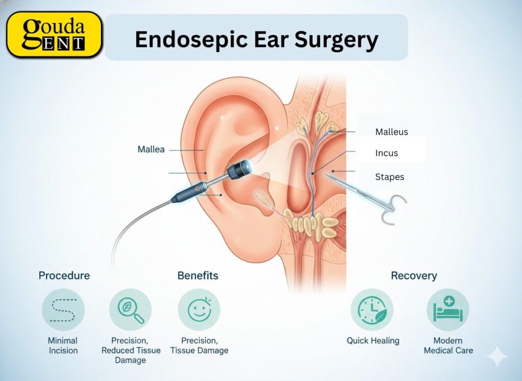 Detailed diagram of endoscopic ear surgery showing the ear anatomy (Malleus, Incus, Stapes) and the minimally invasive procedure used for treatment