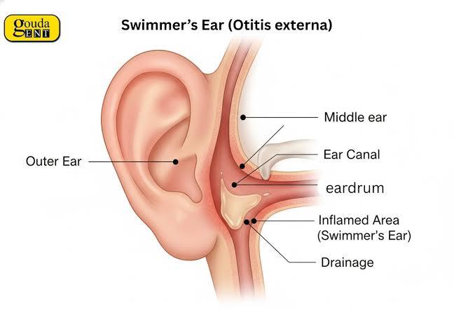 How Long Does Swimmer's Ear Last?